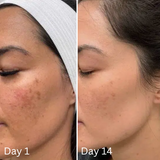 Alpha Arbutin - whitening+ anti melasma 30ml for men & women
